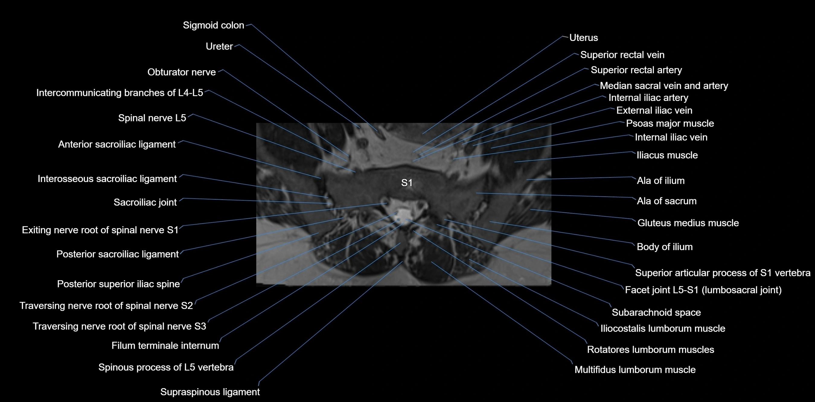MRI sacrum, coccyx and sacroiliac joint axial cross sectional anatomy 3T  radiology  image-img-00001-00012.webp